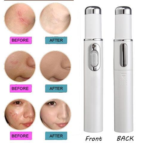 Blue Light Therapy Acne Laser Pen Scar Wrinkle Removal.