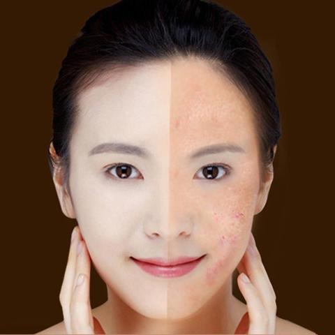Blue Light Therapy Acne Laser Pen Scar Wrinkle Removal.